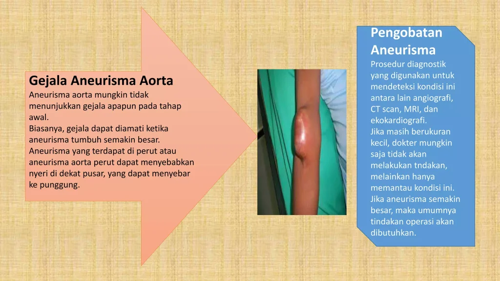 Gejala Aneurisma Yang Harus Segera Ditangani Panduan Lengkap Untuk Kewaspadaan Dini