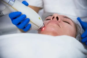 Apa Efek Laser Penghilang Jerawat 1