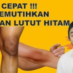 Bagaimana Cara Memutihkan Siku Yang Hitam