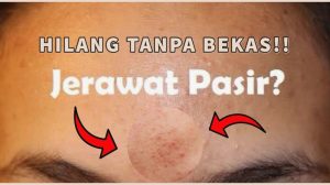 Bagaimana Cara Menghilangkan Jerawat Pasir Di Jidat