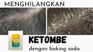 Bagaimana Cara Menghilangkan Ketombe Dengan Baking Soda