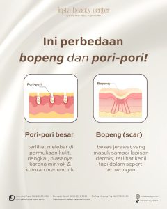 Kenapa Pori Pori Membesar
