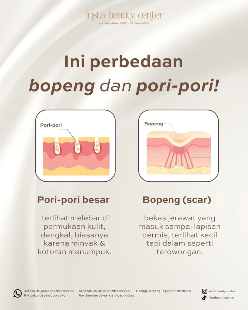 Kenapa Pori Pori Membesar