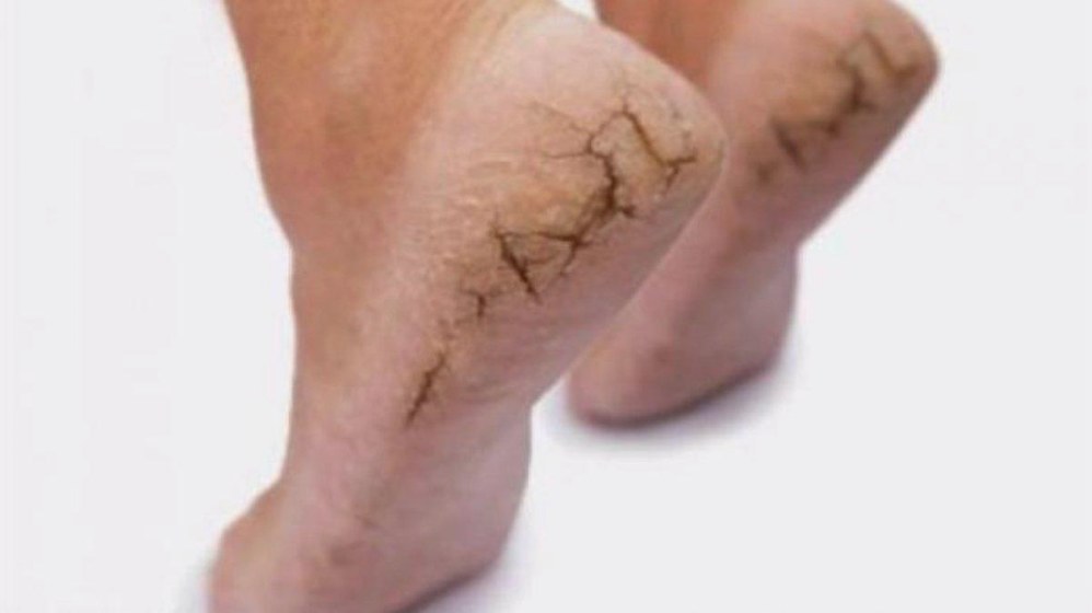 Kenapa Tumit Kaki Pecah Pecah